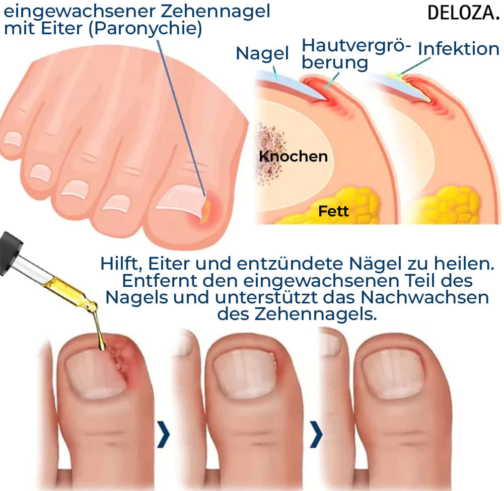 NailHeal™ - Reparatur beschädigter Nägel in 4 Wochen [1 + 1 Gratis]