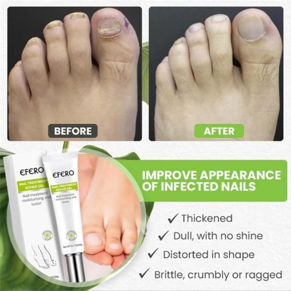 RejuveNail™ – Für nachhaltig stärkere, gesunde und schöne Nägel [1 + 1 Gratis]
