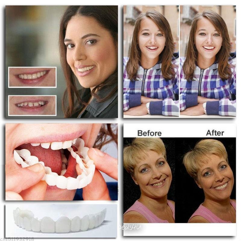 SnapOn™ – Aufsteckbare Prothese für ein strahlendes Lächeln [1 + 1 Gratis]