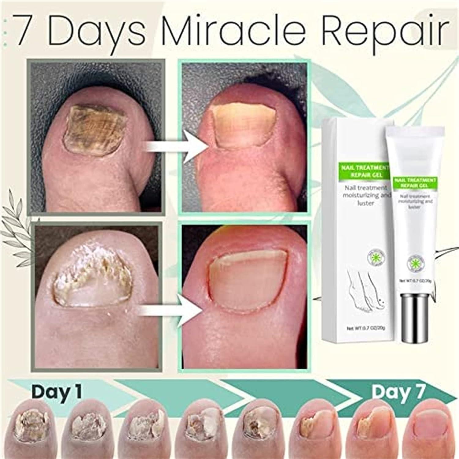 RejuveNail™ – Für nachhaltig stärkere, gesunde und schöne Nägel [1 + 1 Gratis]