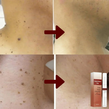 1 + 1 Gratis |  WipeOff™ - Hartnäckige Flecken und Warzen entfernen