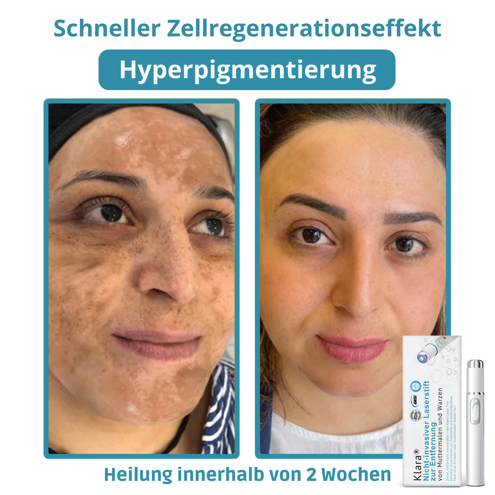 Hautpflege Gerät Für Kosmetische Anwendung Zuhause product image 10