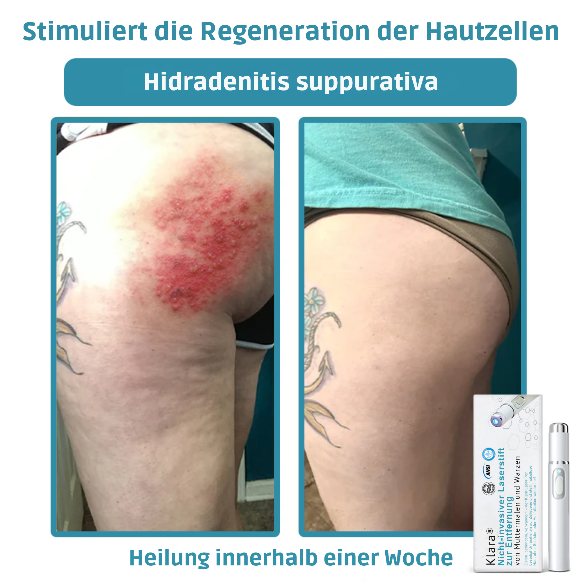 Hautpflege Gerät Für Kosmetische Anwendung Zuhause product image 11