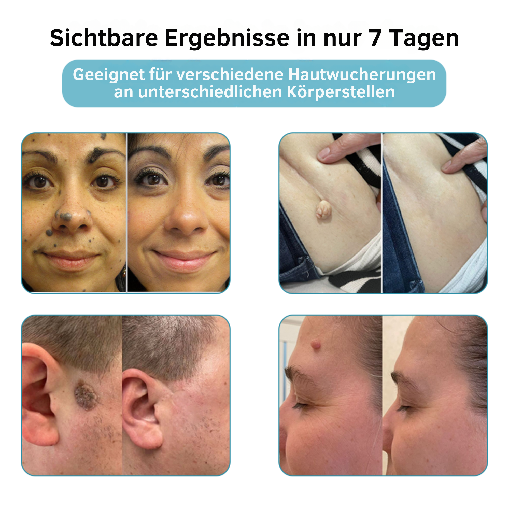 Hautpflege Gerät Für Kosmetische Anwendung Zuhause product image 3