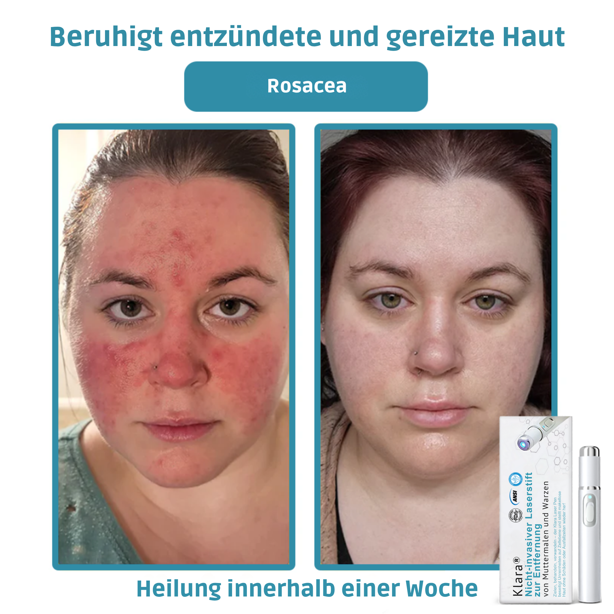 Hautpflege Gerät Für Kosmetische Anwendung Zuhause product image 7