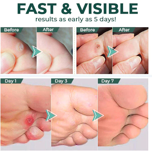 CleanFeet™ – Hühneraugen- und Hornhautentferner für besonders starke, schnelle Linderung [1 + 1 Gratis]