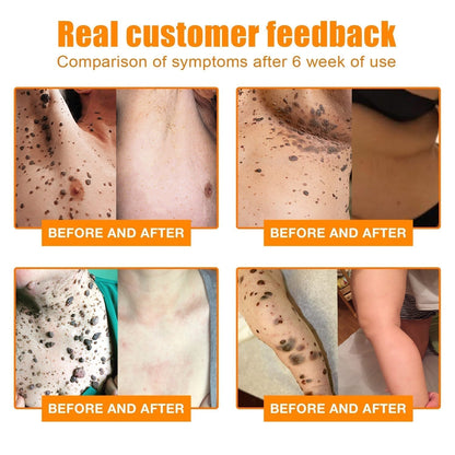 NewYou™ TagLift Bienengift-Behandlung – Schmerzfreie Hauterneuerung für klare, selbstbewusste Haut [1 + 1 Gratis]