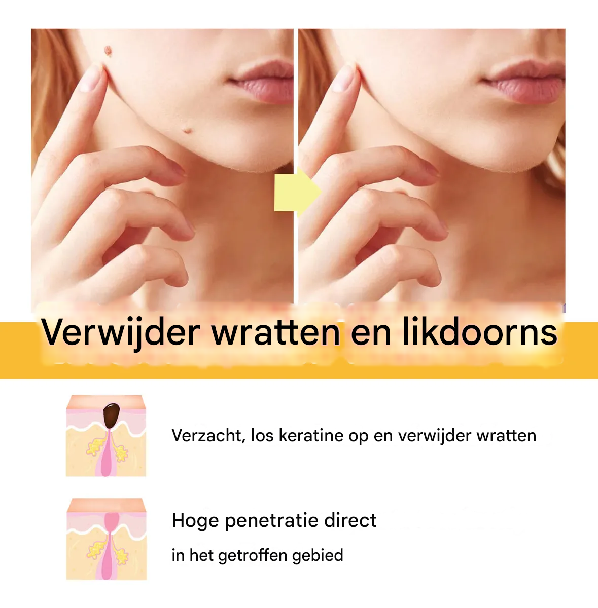 BeeNaturale™ – Sanfte und effektive Entfernung von Hautflapjes und Flecken [1 + 1 Gratis]