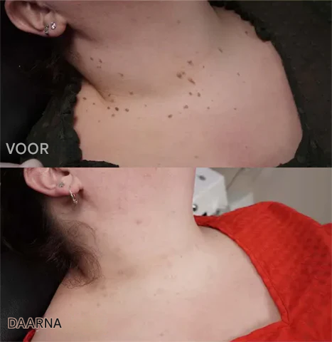 BeeNaturale™ – Entfernt Hautflapjes und Flecken sanft und effektiv [1 + 1 Gratis]